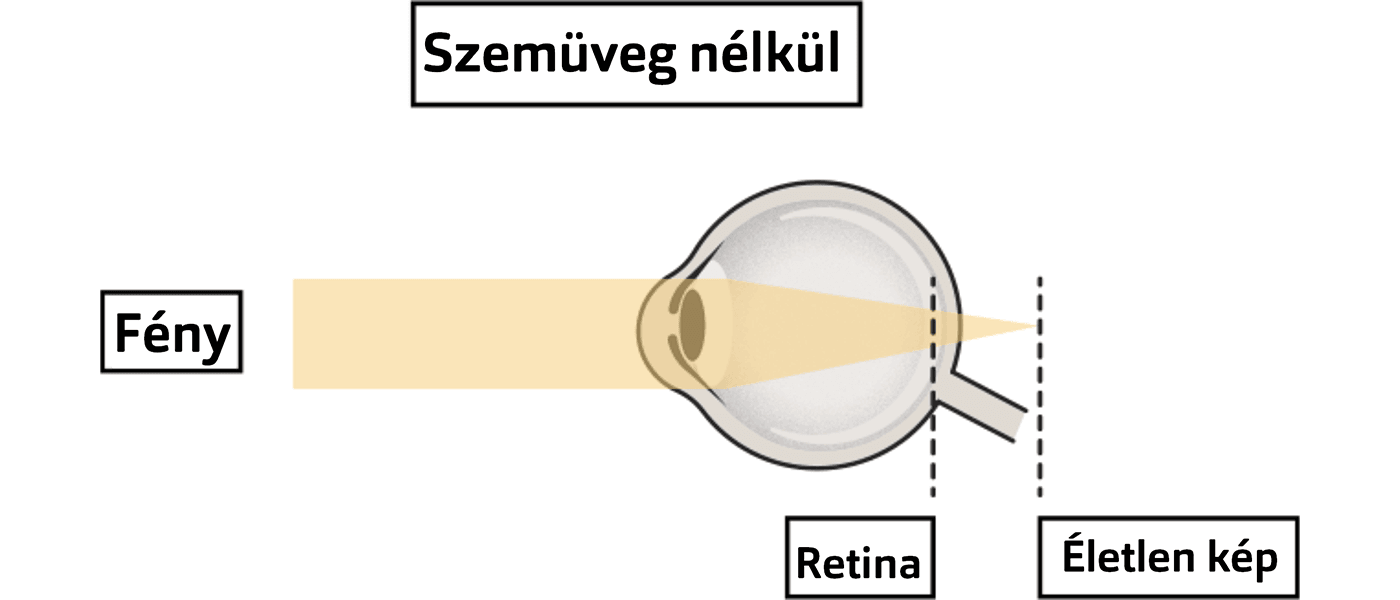 távollátás